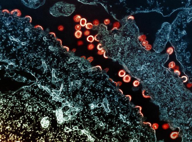 Transmission electron micrograph of HIV-1 virus particles (red/yellow) budding and replicating from a segment of a chronically infected H9 cell (blue/teal). 