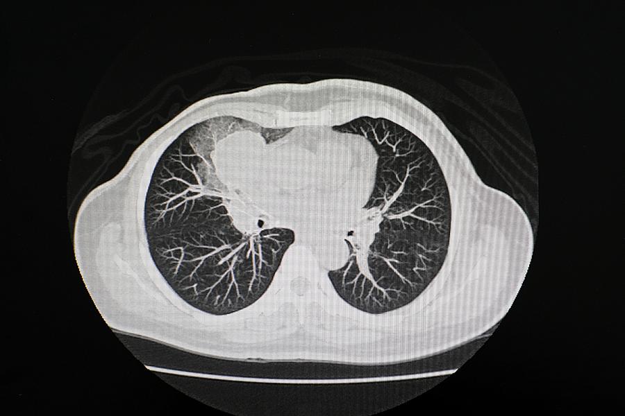 Image of a CT scan of chest organs