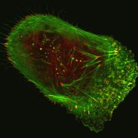 Human malignant melanoma cell viewed through a fluorescent, laser-scanning confocal microscope.