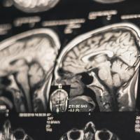 Image of a brain MRI scan