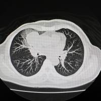 Image of a CT scan of chest organs